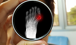 Effective Treatment for Bunion Pain: Minimally Invasive Options